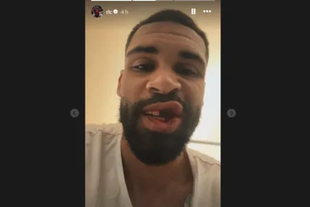 Atacante inglês exibe arcada dentária após fratura na mandíbula em partida do Milan